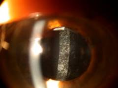 Cataracts 9