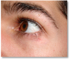 Chalazion corticosteroid injection