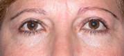 Blepharoplasty 33