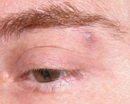 Eyelid trauma 6