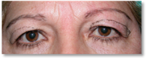 Dermatocalasia 6