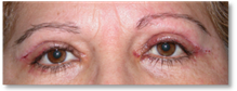 Dermatocalasia 8