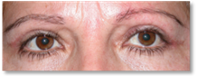 Dermatocalasia 9