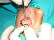 Fracturas orbitarias 3