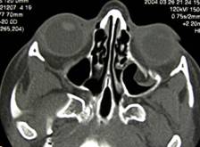 Fracturas orbitarias 4
