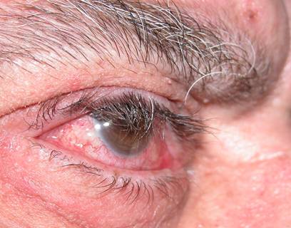 Hiperlaxitud palpebral 3