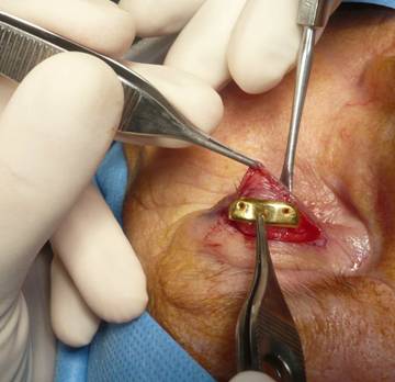 Paralisis facial 3