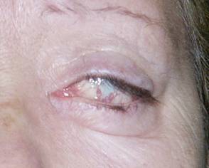 Paralisis facial 4
