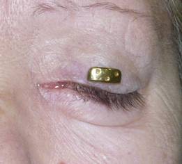 Paralisis facial 5