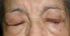 Paralisis facial 7