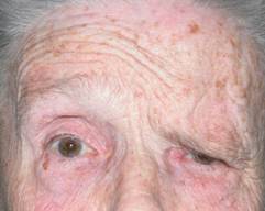 Paralisis facial 8