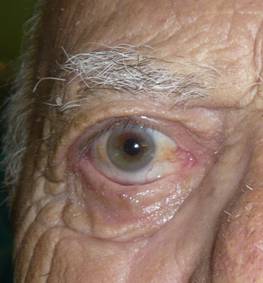 Paralisis facial 10