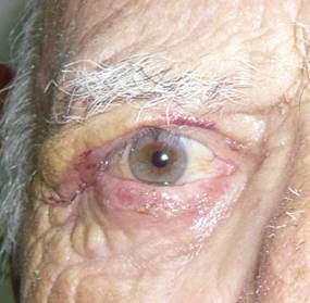 Paralisis facial 11