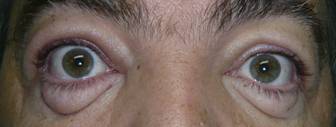 Blefaroplastia 2
