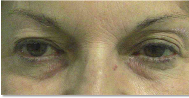 Blefaroplastia 12