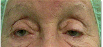 Blefaroplastia 14