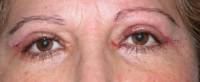 Blefaroplastia 31