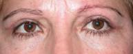 Blefaroplastia 32