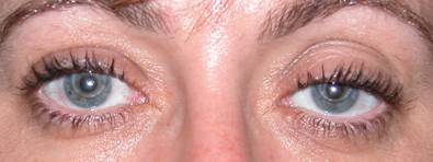 Ptosis palpebral 1