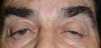 Ptosis palpebral 9