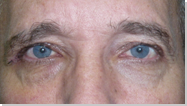 Ptosis palpebral 13