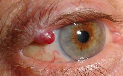 Tumores palpebrales 1