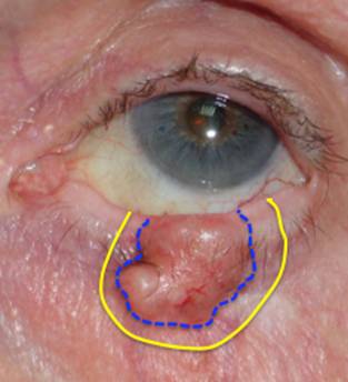 Tumores palpebrales 6