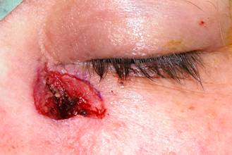 Tumores palpebrales 8