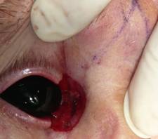 Tumores palpebrales 12