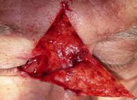 Tumores palpebrales 14